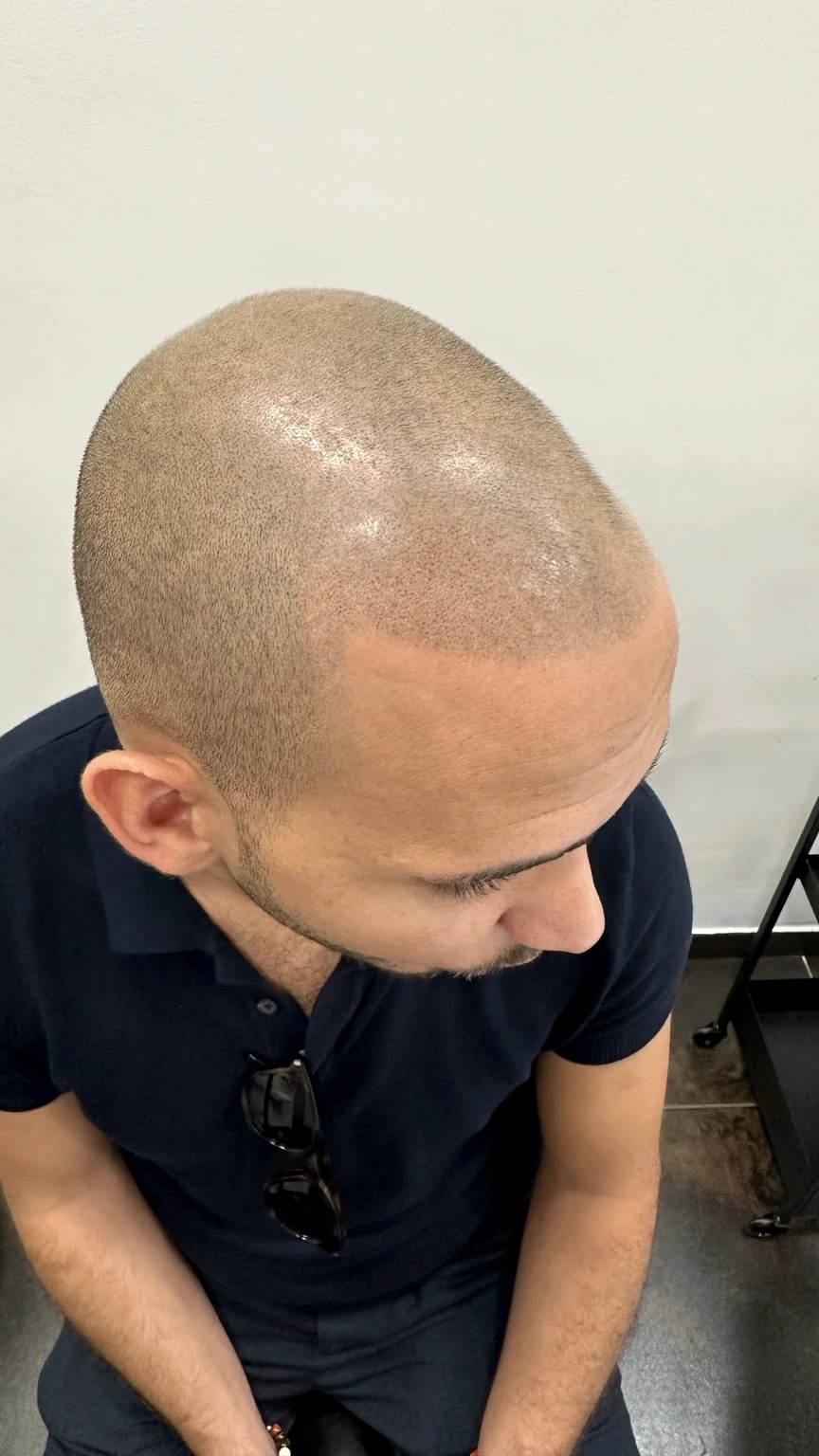 Risultato reale di un trattamento effetto rasato