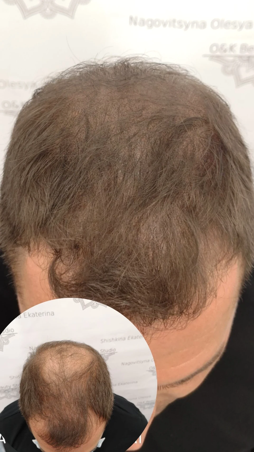 Trattamento di infoltimento ottico con confronto fotografico su capelli presenti
