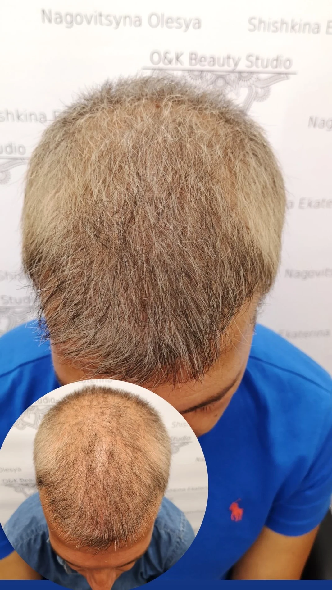 Fotografia reale di infoltimento ottico su capelli presenti